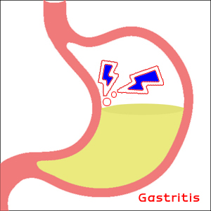 GastritisPolypharmacy